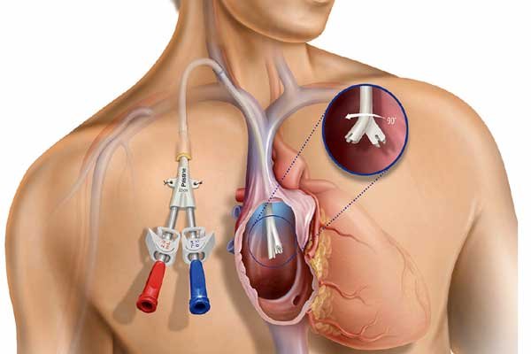 Dialysis catheter insertion in Nagpur